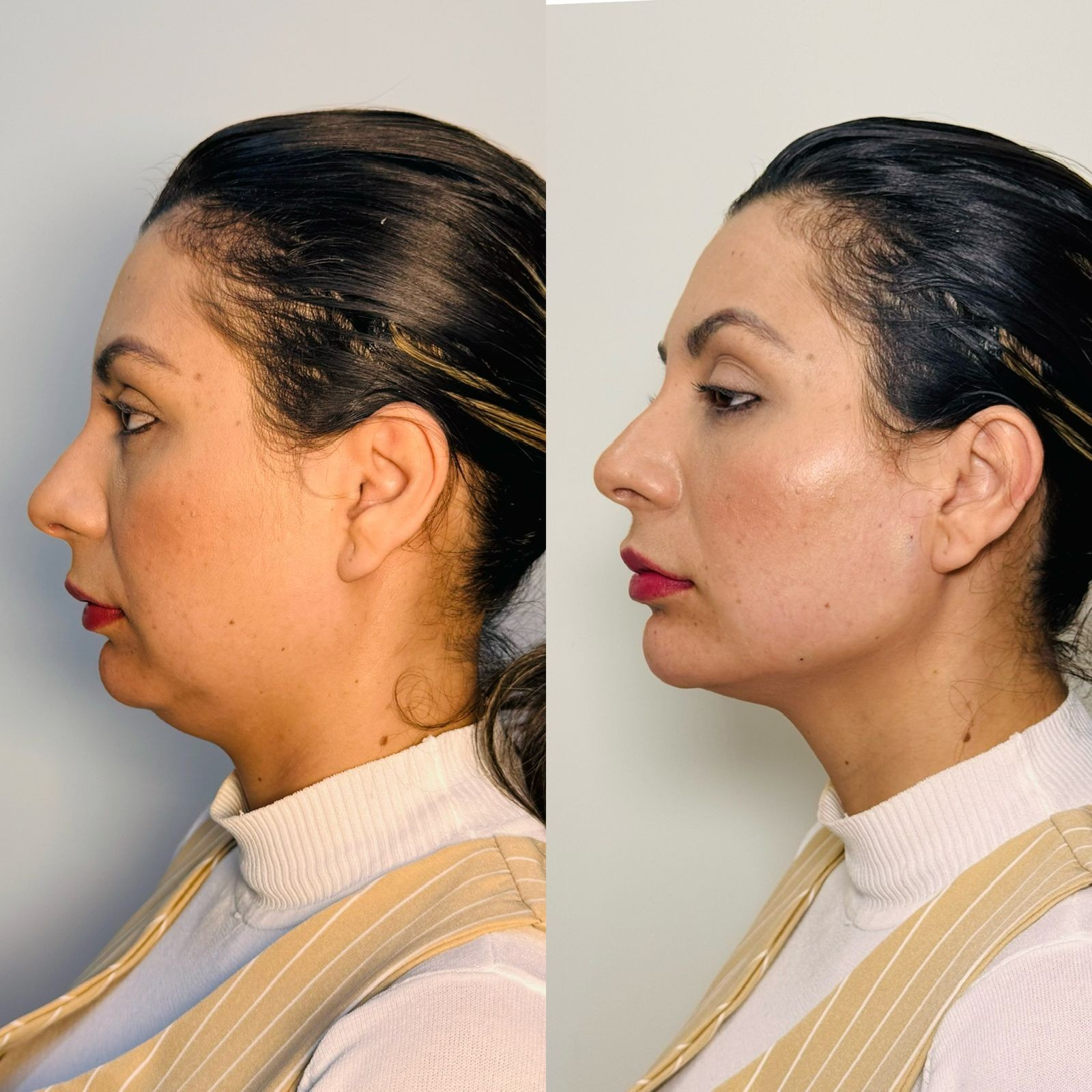 Antes e depois dePreenchimento de Mandíbula