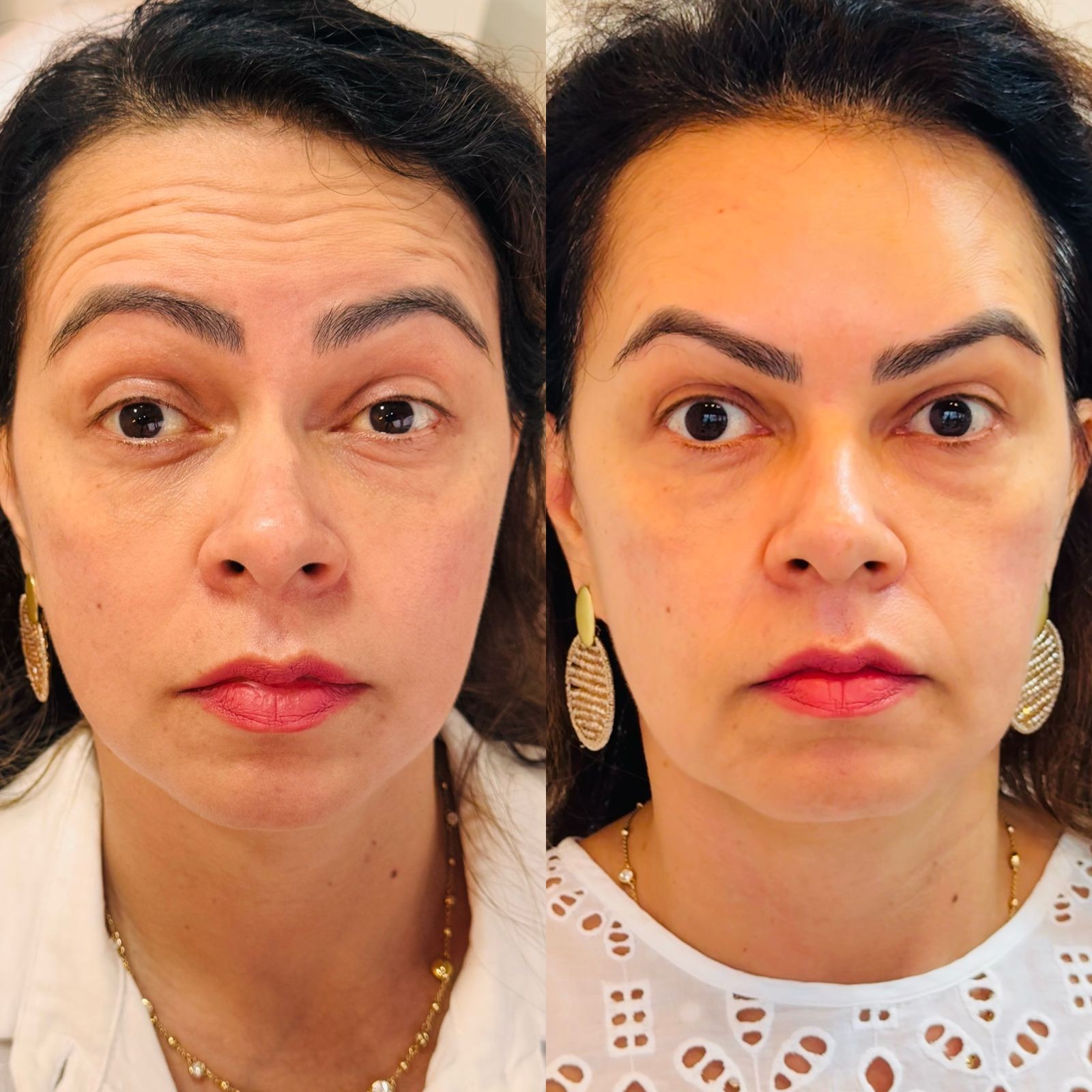 Antes e depois deTratamento de Rugas